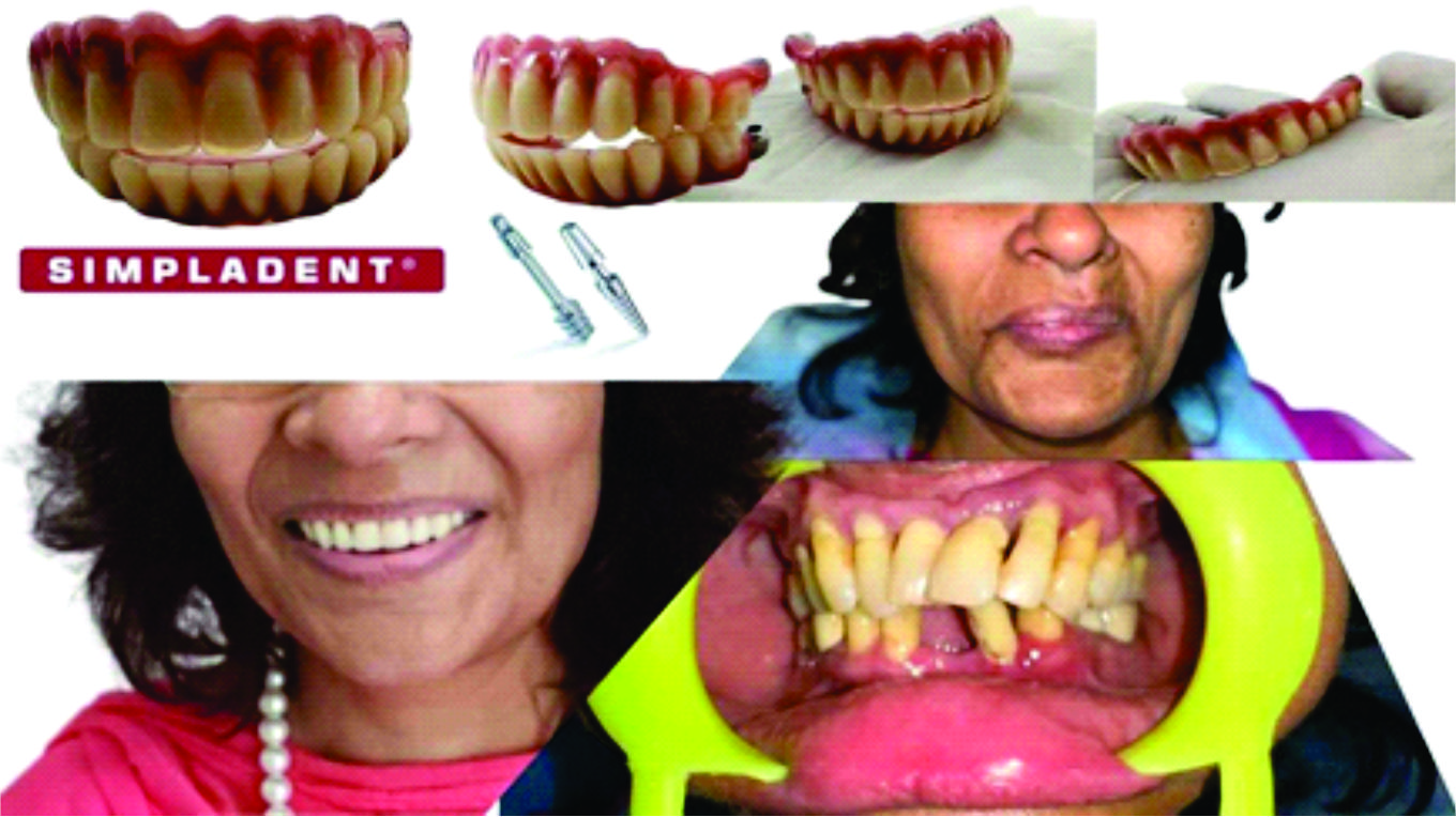 Simpladent Clinics Unveils Revolutionary Corticobasal Dental Implant Clinic for Immediate Tooth Replacement Simpladent Clinics