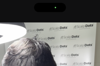 Scalp Micropigmentation