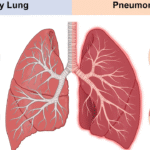 Pneumonia